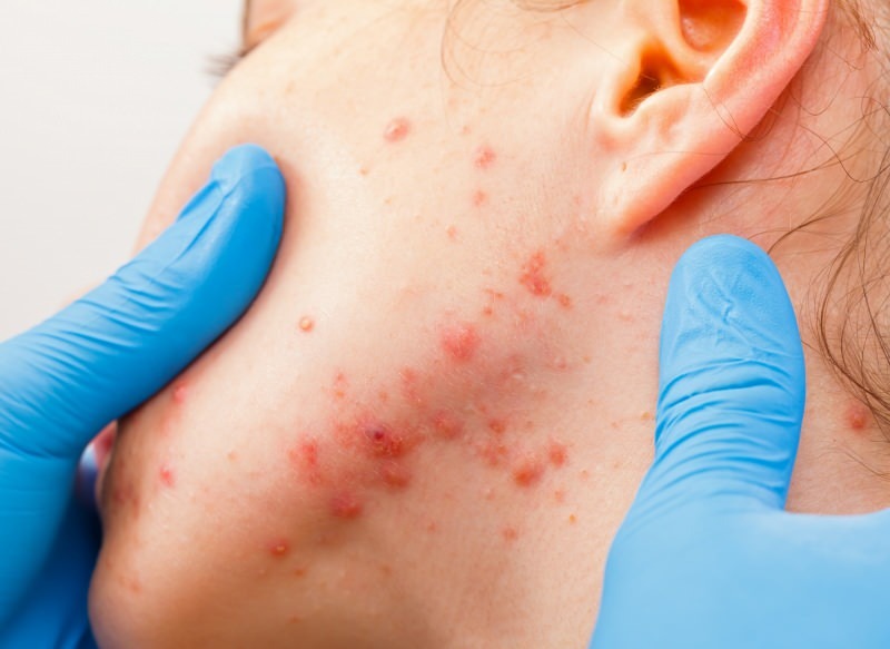 Ο ιός προκαλεί φουσκάλες στην επιφάνεια του δέρματος