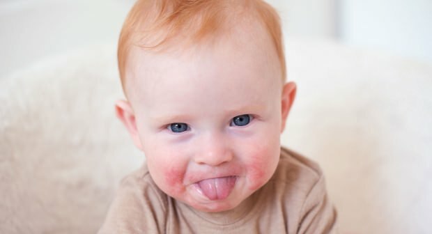Προσοχή στα μωρά με κόκκινα μάγουλα! Το σύνδρομο του μάγουλο και τα συμπτώματα του