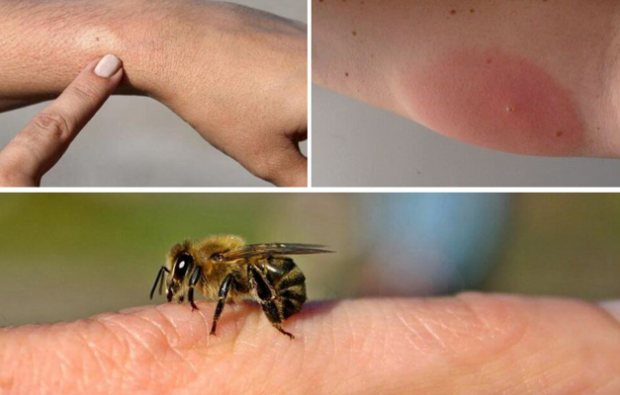 συμπτώματα αλλεργίας μελισσών