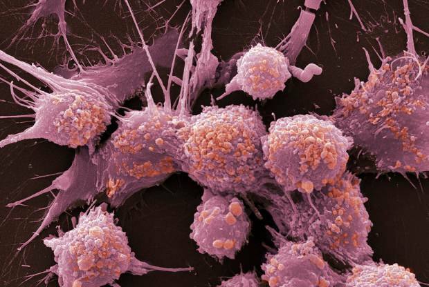 Τι είναι ο καρκίνος και ποια είναι τα συμπτώματά του; Πόσα είδη καρκίνου υπάρχουν; Πώς προλαμβάνεται ο καρκίνος;
