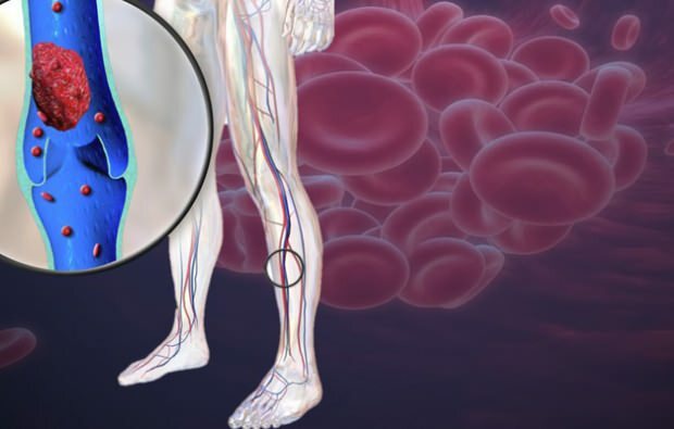 η μειωμένη κυκλοφορία του αίματος στις φλέβες των ποδιών προκαλεί πόνο