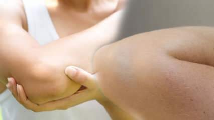 Προκαλεί μαυρισμό των αγκώνων; Φυσικές μέθοδοι για το σκοτάδι του αγκώνα